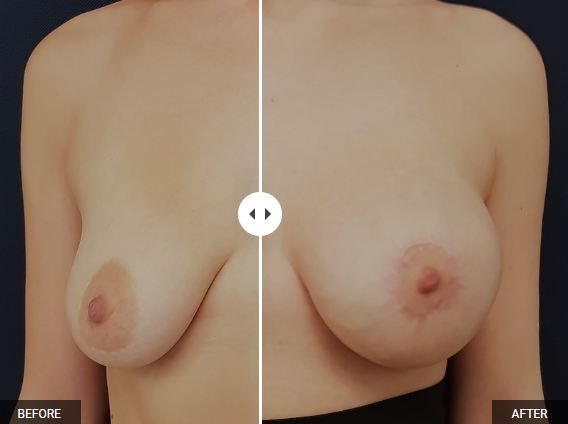 Operacja powiększenia biustu - zdjęcia przed i po zabiegu