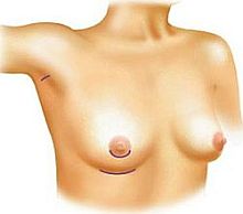 Rodzaje cięć chirurgicznych przy operacjach powiększenia biustu